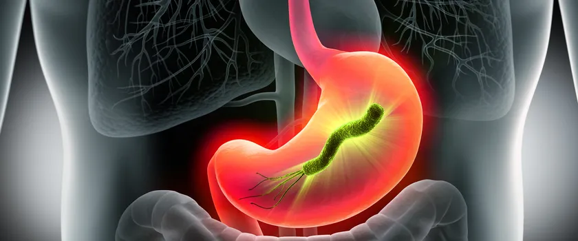 Helicobacter pylori.