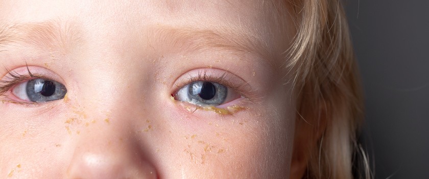Ropiejące oczy u dziecka – przyczyny, dodatkowe objawy i sposoby łagodzenia problemu