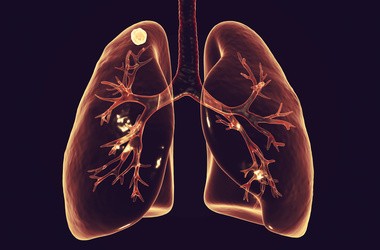 Ilustracja przestawiająca schemat płuc wraz z guzkami.
