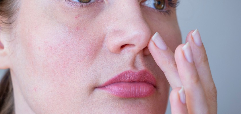 trądzik różowaty