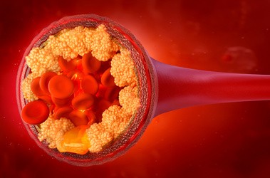 Jak obniżyć poziom cholesterolu całkowitego?