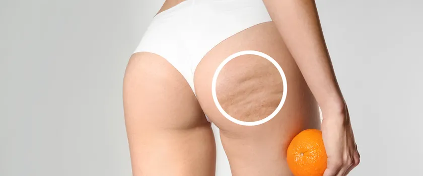 cellulit u kobiet