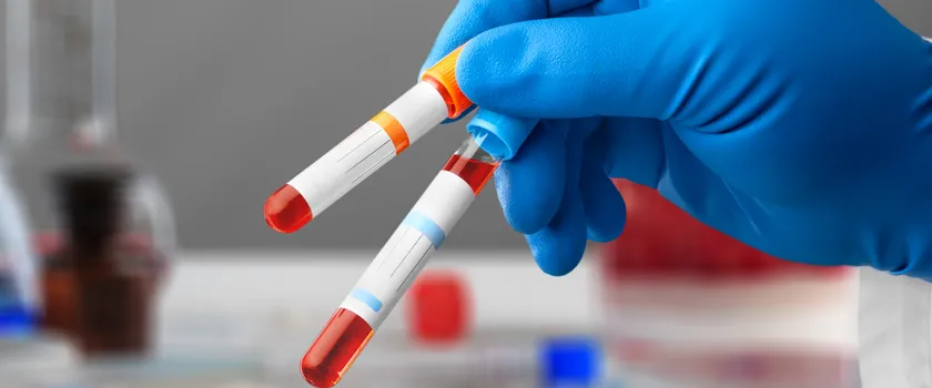 Pracownik laboratorium trzyma w dłoniach dwie próbówki z krwią pacjenta do badania.