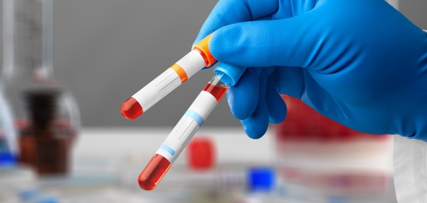Pracownik laboratorium trzyma w dłoniach dwie próbówki z krwią pacjenta do badania.