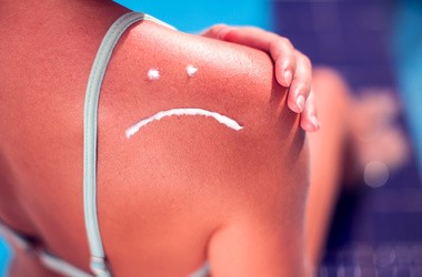 Kobieta z kremem przeciwsłonecznym na spalonej skórze w kształcie smutnego uśmiechu.