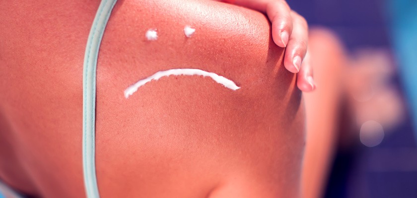 Kobieta z kremem przeciwsłonecznym na spalonej skórze w kształcie smutnego uśmiechu.