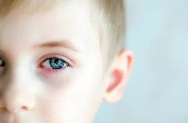 Zapalenie spojówek u blond chłopca o niebieskich oczach.