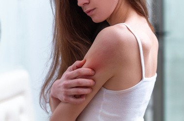 atopowe zapalenie skóry u kobiety