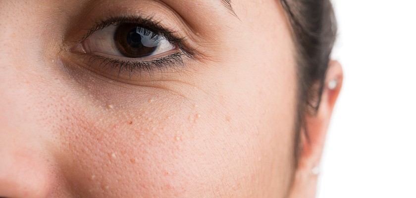 Prosaki na twarzy kobiety.