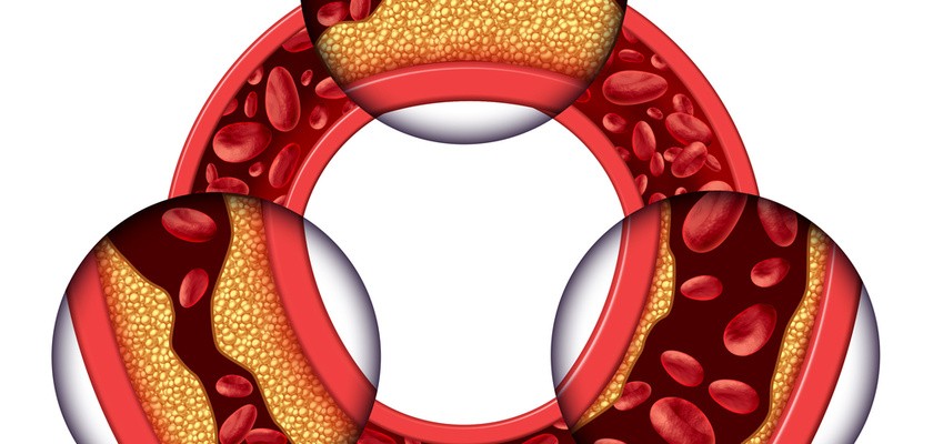 Jak rozpoznać objawy choroby wieńcowej i jak ją leczyć?