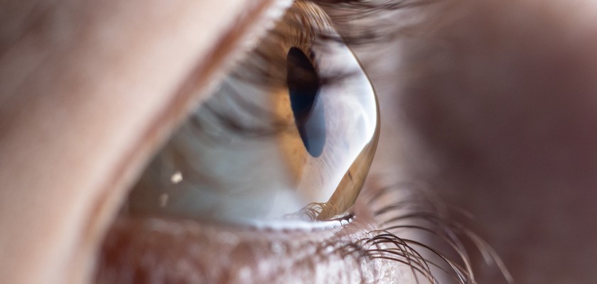 Zdjęcie oka z astygmatyzmem.