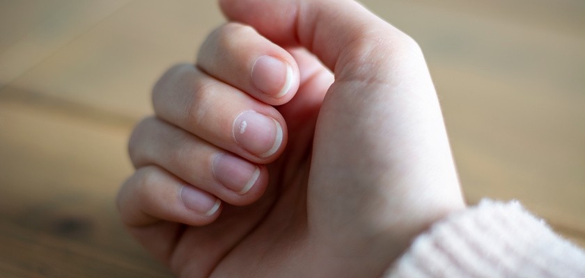 baiłe plamki na paznokciach