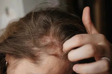 łuszczyca skóry głowy u kobiety z długimi włosami, która drapie głowę