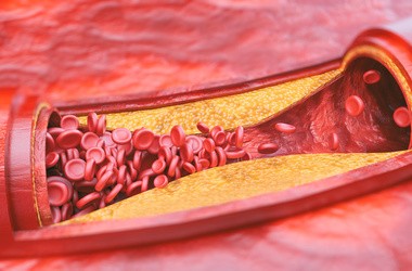 Schemat przedstawiający miażdżycę tętnic.