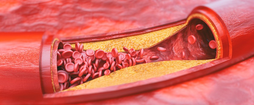 Schemat przedstawiający miażdżycę tętnic.