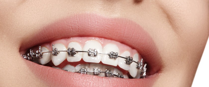 Po co zakłada się aparat na zęby? Rodzaje i ceny aparatów ortodontycznych