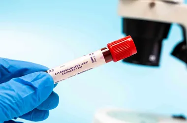 Próbka krwi - badanie przeciwciał CMV, cytomegalowirus, cytomegalia.
