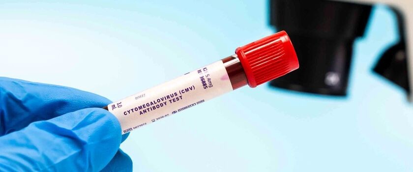 Próbka krwi - badanie przeciwciał CMV, cytomegalowirus, cytomegalia.