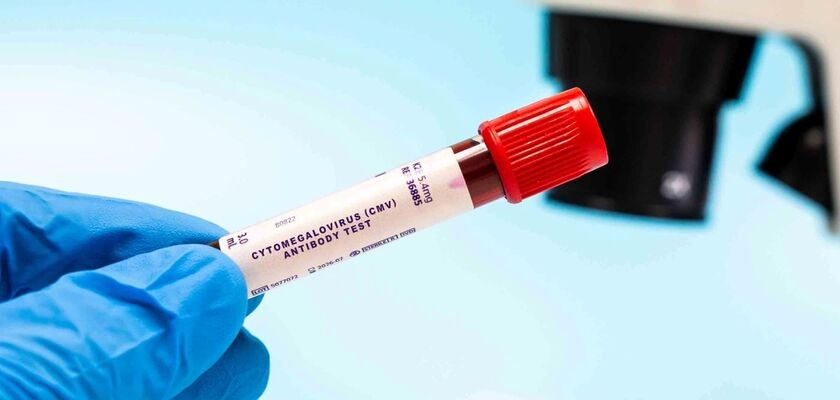 Próbka krwi - badanie przeciwciał CMV, cytomegalowirus, cytomegalia.