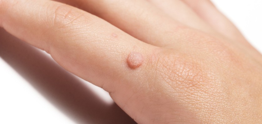 Kurzajka – czym jest i jak można się jej pozbyć domowymi sposobami?