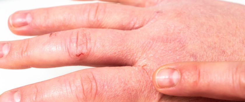 Egzema na dłoniach – objawy, przyczyny i sposoby leczenia