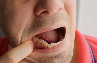 Mężczyzna pokazuje w jamie ustnej przetokę zębową.