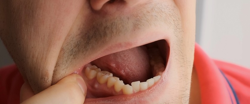 Mężczyzna pokazuje w jamie ustnej przetokę zębową.