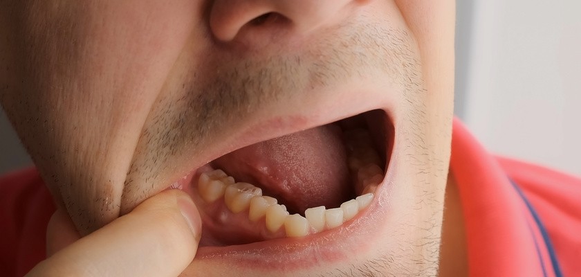 Mężczyzna pokazuje w jamie ustnej przetokę zębową.