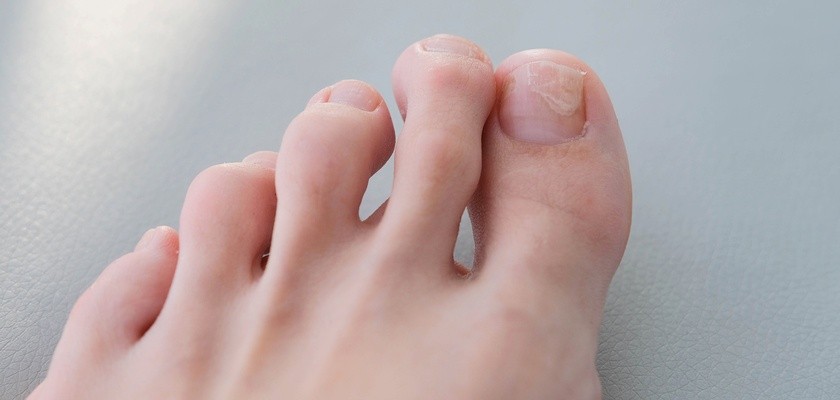 chore paznokcie u stóp