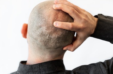 Sucha skóra głowy u mężczyzny krótko obciętego