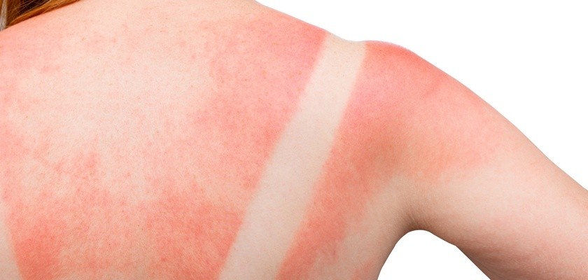 zaczerwienione po opalaniu plecy