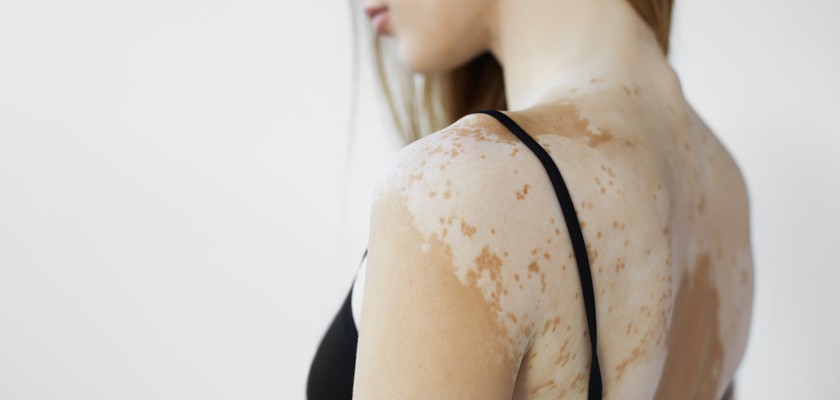 Kobieta ze stanem skóry, który powoduje utratę melaniny pozującej w pomieszczeniu. Szczupła kobieta w czarnym podkoszulku.