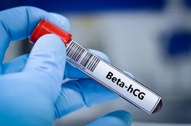 Badanie beta hcg wykryje ciążę na wczesnym etapie.