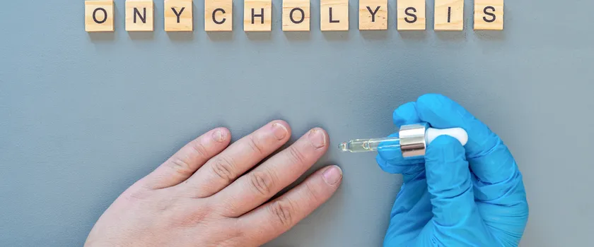 Onycholiza paznokcia. Napis Onycholysis drewnianymi literami na szarym tle. Specjalista nakłada specjalny preparat na regenerację paznokci.
